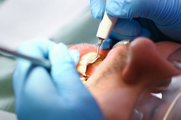 Best Urgent Care for Lost Fillings or Crowns in Eulyptus Hills, CA